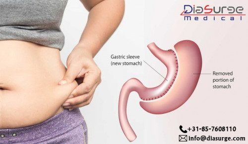 Sleeve gastrectomy is done with laparoscopy equipment, to help you lose excess weight & reduce your risk of potentially life-threatening weight-related health problems.
For more visit: https://bit.ly/2UzJwSQ