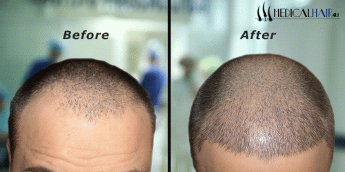 From minimally invasive surgeries to timely aftercare, know more about hair transplant treatment from the consultants at MedicalHair4U.com. Call us at +44 20 7108 6246.