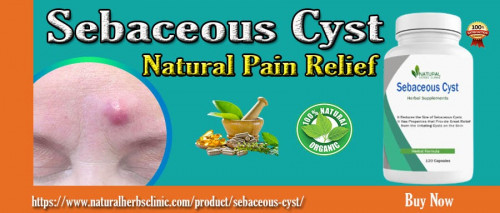 Sebaceous Cyst Supplement