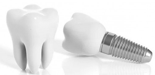 Da li ste spremni u svoje tijelo ugraditi jeftine zubne implantate upitne kvalitete? Ove informacije će Vam pomoći da odlučite koji ćete dentalni centar odabrati gdje ćete ugraditi svoj zubni implantati.

Posjetite na:- https://www.treedent.hr/zubni-implantati

Riješite svoje probleme bezubosti s premium dentalnim implantatima

Zubni ili dentalni  implantati

Mobilna proteza ili implantati? Cjenovno je razlika velika ali je i velika razlika u kvaliteti života. Što se tiče rješenja bezubosti proteze su stvar prošlog stoljeća i premda se još dan danas rade u ordinacijama i dio su stomatološke prakse,  tehnološki napredak i noviteti po pitanju proteza stagniraju. Dentalna industrija i tržište se okrenulo implantatima i svakim danom možemo svjedočiti novim spoznajama i rješenjima na području implantološke terapije.   

TreeDent Varaždin Vam nudi usluge kompletnih rekonstrukcija čeljusti od ugradnje pojedinih implantata do kompleksnih protetskih rješenja All on 4 i All on 6 ovisno o vašim potrebama i zdravstvenoj situaciji.