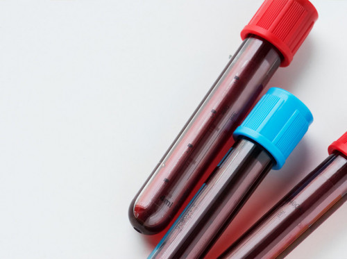 Descubra el costo total de un conteo sanguíneo completo, esta prueba evalúa su salud general y detecta una amplia gama de trastornos, como anemia, infecciones y leucemia. Visite nuestro sitio web hoy para más información


https://enterate.com/costo-de-un-hemograma-completo-en-miami/