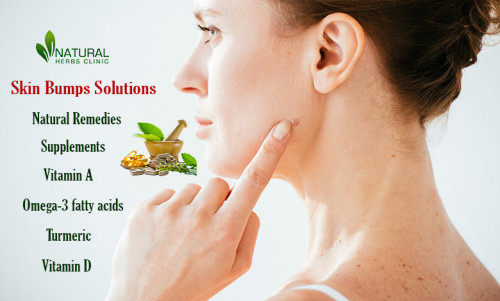The treatment for skin bumps depends on the underlying cause of the bumps. It’s important to consult with a healthcare professional. https://www.naturalherbsclinic.com/blog/skin-bumps-problem-the-trendy-solutions-you-need-to-try