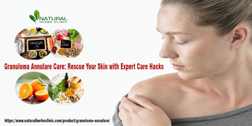 Get the expert advice you need to your Granuloma Annulare Care and treatment. Discover simple hacks and tips for taking care of your skin and living a healthier life. https://wt.social/post/health/ojcr3en5677131819306