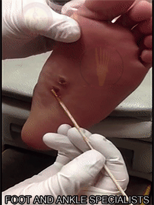 Wart-treatment-in-Naperville-IL.gif