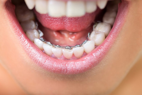 What-You-Should-Know-About-Lingual-Braces.jpg