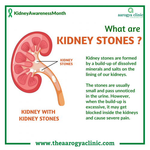 Homeopathic treatment for Kidney stone in Vellore, India | aarogya clinic provides the best natural ways of homeopathy to get rid of kidney stones.

To know more log on to www.theaarogyaclinic.com or contact us @+91 9789114955