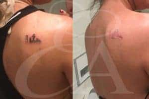 exclusive-aesthetic-tattoo-removal-1-300x200.jpg