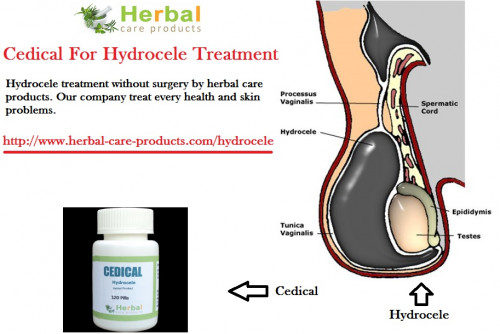 It is not dangerous and treated only when they cause pain and when they decrease the blood supply to the penis.  Some of the Natural Remedies for Hydrocele and herbs for Hydrocele are effective to reduce the swelling in your scrotum.   Following are some Herbal Treatment for Hydrocele.