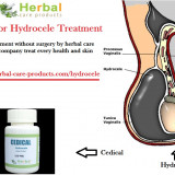 hydroceleNatural-Treatment-for-Hydrocele