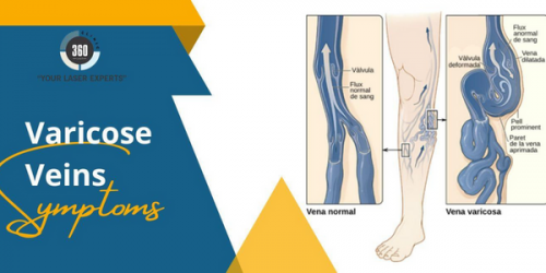 The treatment for varicose veins should never be ignored. Immediate consultancy of specialists is required for better healing.
https://laser360clinic.com/know-about-varicose-veins-symptoms-and-treatments/